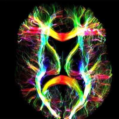 MRI image - white matter fibres in the human brain